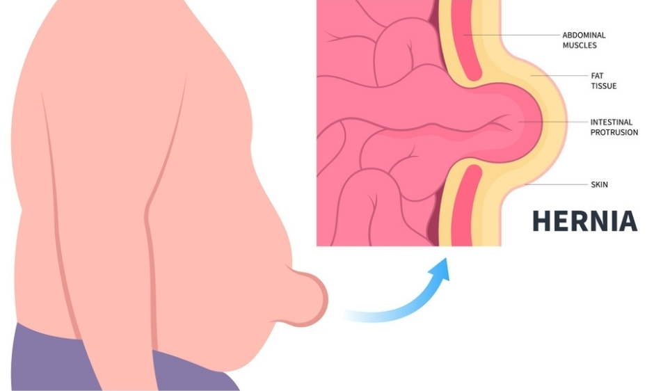 best ventral hernia treatment